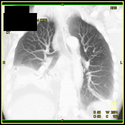 Collapsed Right Lower Lung - CTisus CT Scan