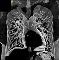 VRT of the Lung - CTisus CT Scan