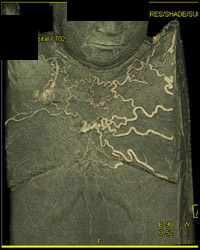Collaterals in Chest Wall - CTisus CT Scan