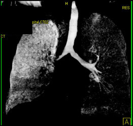 Narrowed Right Mainstem Bronchus - CTisus CT Scan