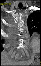 Nonunion Sternum - CTisus CT Scan