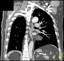 Increased Mediastinal Fat - CTisus CT Scan