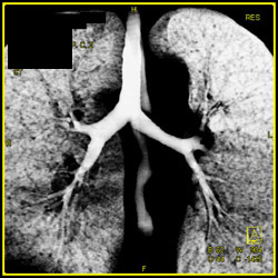 3D of the Airway - CTisus CT Scan