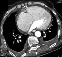 Amyloidosis - CTisus CT Scan