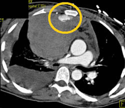 Anterior Mediastinal Bleed S/P Trauma - CTisus CT Scan