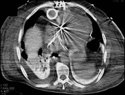 Left Ventricular Assist Device (LVAD) - CTisus CT Scan