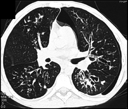 Bronchiectasis - CTisus CT Scan