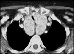 Substernal Thyroid - CTisus CT Scan