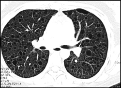 Lam - CTisus CT Scan