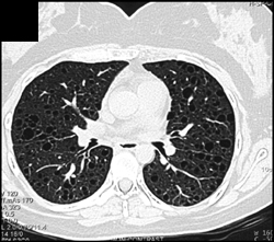 Lymphangioleiomyomatosis (LAM) - CTisus CT Scan