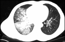 Aspiration Pneumonia - CTisus CT Scan