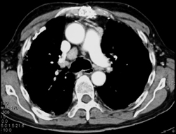 Asbestosis With Pleural Plaques - CTisus CT Scan