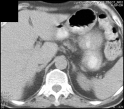 Lung Cancer With Hot Right Adrenal on PET Scan - CTisus CT Scan