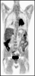Lung Cancer on PET/CT With Right Adrenal Metastases - CTisus CT Scan