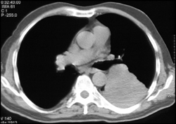 Lung Cancer Without Definite Adrenal Metastases on Ct - CTisus CT Scan