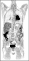 Lung Cancer on PET/CT - CTisus CT Scan