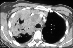 Lung Cancer Encases and Occludes the SVC - CTisus CT Scan