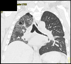 Interstitial Fibrosis in Native Right Lung - CTisus CT Scan
