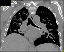 Stent in Left Mainstem Bronchus S/P Lung Tx - CTisus CT Scan