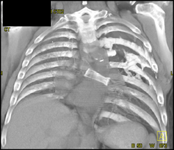 Emphysematous Native Right Lung - CTisus CT Scan