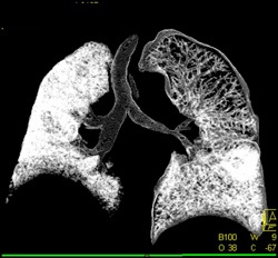 Virtual Bronchoscopy With Diseased Native Right Lung and Narrowing at Anastomosis on Left - CTisus CT Scan