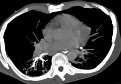 Aspiration Into Right Lower Lung Bronchus - CTisus CT Scan