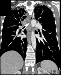 Stent in Right Mainstem Bronchus. Lung Cancer Encases Right Mainstem and Trachea - CTisus CT Scan