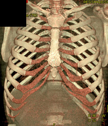 Normal Costal Cartilage - CTisus CT Scan