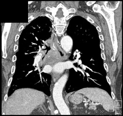 Lung Cancer Encases Right Mainstem Bronchus - CTisus CT Scan