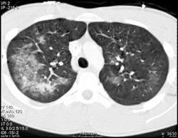 Pulmonary Hemorrhage - CTisus CT Scan