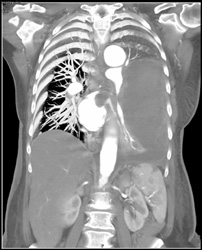 Lung Sarcoma Nodules in Left Atrium - CTisus CT Scan