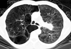 Lung Cancer With Emphysema - CTisus CT Scan