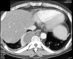 Posterior Mediastinal Abscess - CTisus CT Scan