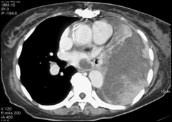 Metastatic Melanoma to Lungs, Pleura, and Left Atrium - CTisus CT Scan