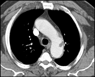 Thrombus in Aortic Arch - CTisus CT Scan