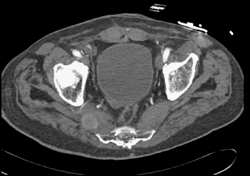Metastases to Piriformus Muscle and Sacrum From Lung Cancer - CTisus CT Scan