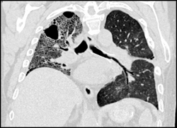 Idiopathic Pulmonary Fibrosis (IPF) Right Lung W/left Lung Transplant - CTisus CT Scan