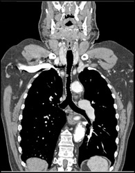 Polyp in Trachea - CTisus CT Scan