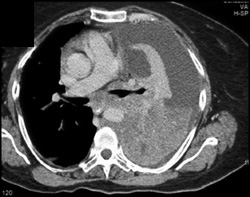 Lung Cancer With Encasement of Airway - CTisus CT Scan