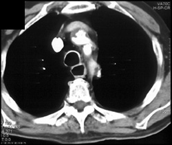 Dilated Esophagus-plaque Aorta - CTisus CT Scan