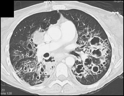 Cystic Fibrosis - CTisus CT Scan
