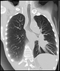 Lung Cancer in Left Hilum and Narrowing Left Mainstem Bronchus With Luminal Tumor - CTisus CT Scan