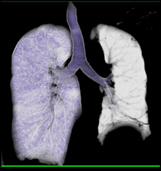 Small Hypoplastic Left Lung With Right Lung Transplant - CTisus CT Scan