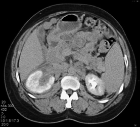 Lymphoma - CTisus CT Scan