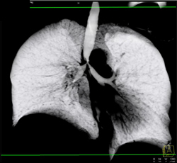 Encasement of Tracheal Bifurcation (carina) - CTisus CT Scan