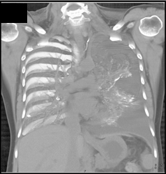 Post Lymphangiogram With Contrast in Left Chest - CTisus CT Scan
