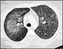 Plastic Bronchitis With Mucus Plug in Right Mainstem Bronchus - CTisus CT Scan