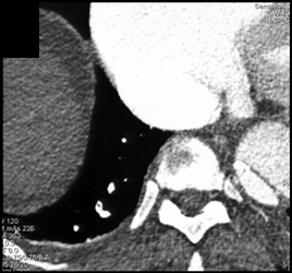 Aortic Dissection and Pulmonary Embolism - CTisus CT Scan