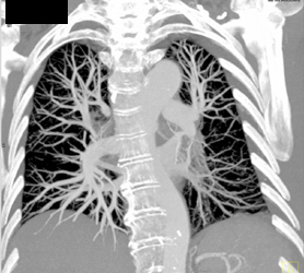Pulmonary Vasculature in MIP - CTisus CT Scan