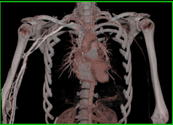 Normal Right Axilla - CTisus CT Scan